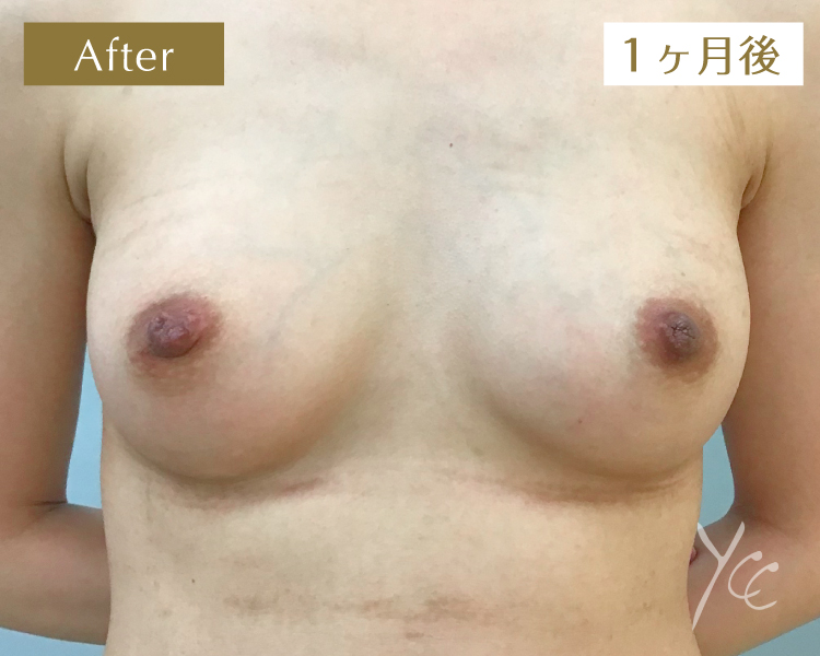 症例15正面施術後