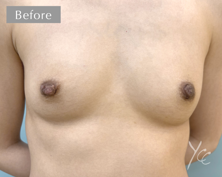 症例15正面施術前