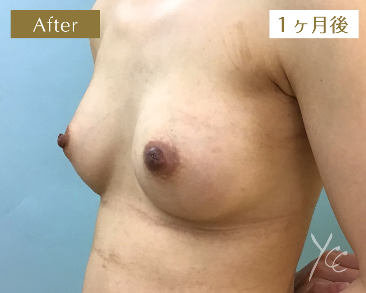 症例15斜め施術後