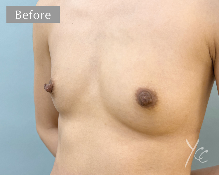 症例15斜め施術前