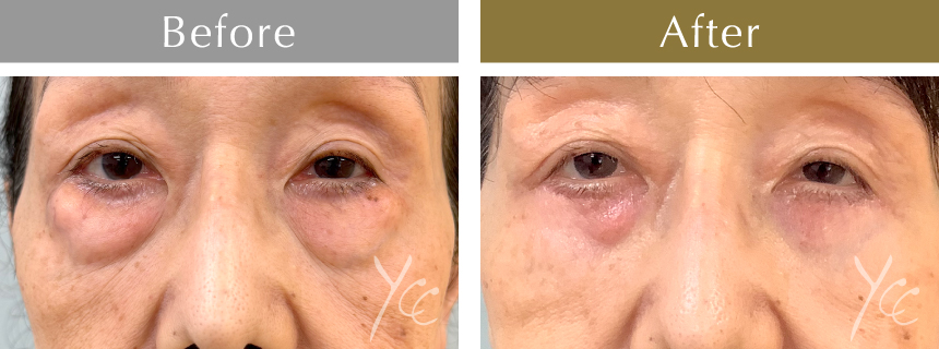 下眼瞼たるみ取り+脱脂症例写真