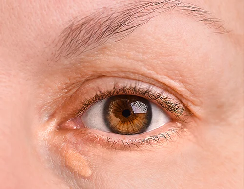 眼瞼黄色腫のイメージ