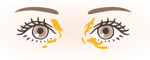 眼瞼黄色腫のイメージ